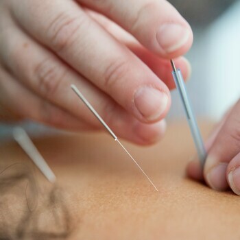 Les acupuncteurs inquiets suite à la disparition de tout cadre législatif